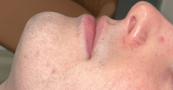 Chin and cheek after Laser Hair Removal