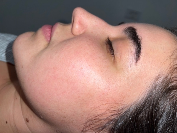 Woman face after rejuvenating procedure