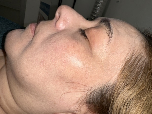 Sideview of a cheek after skin rejuvenating procedure