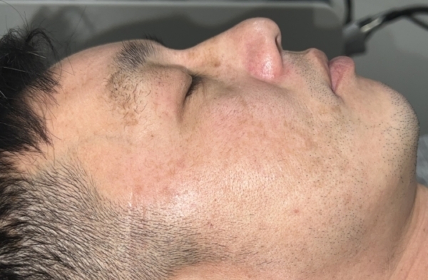 pico genesis, skin rejuvination