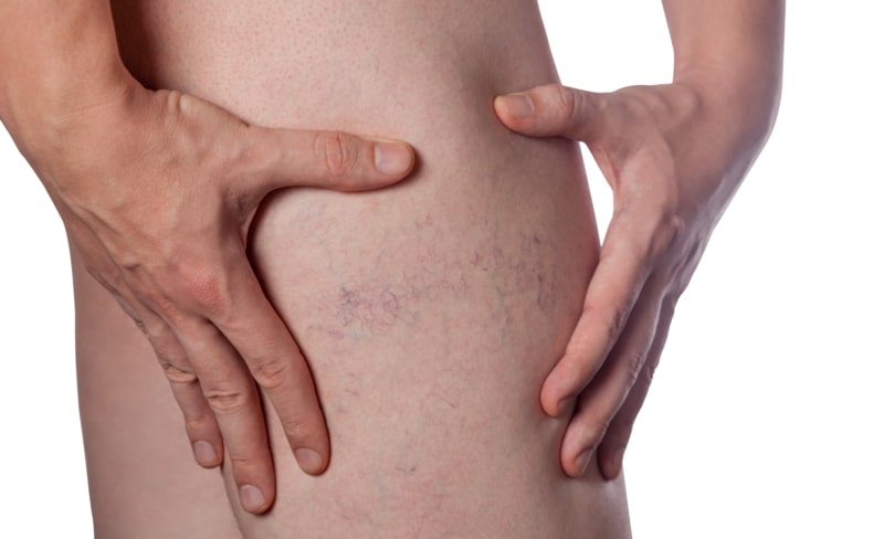 Spider Vein Removal: A Solution for Men’s Skin Concerns