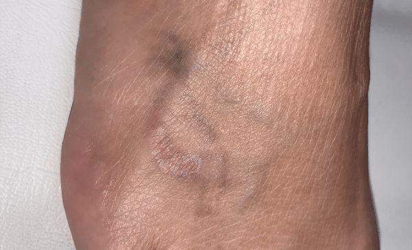 Close up view of a tattoo after laser removal